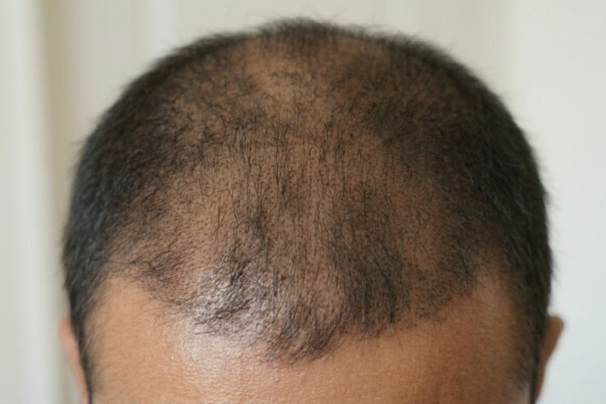 After pigmentation treatment
