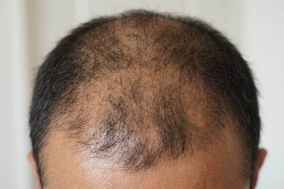 Before pigmentation treatment